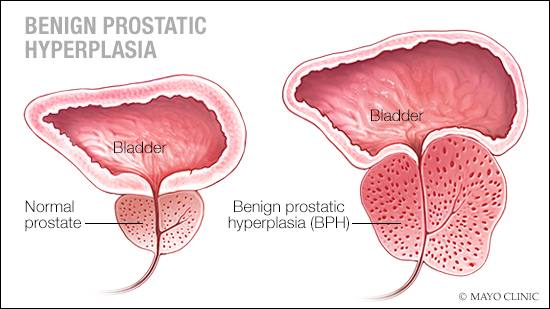What Does It Mean to Have an Enlarged Prostate?